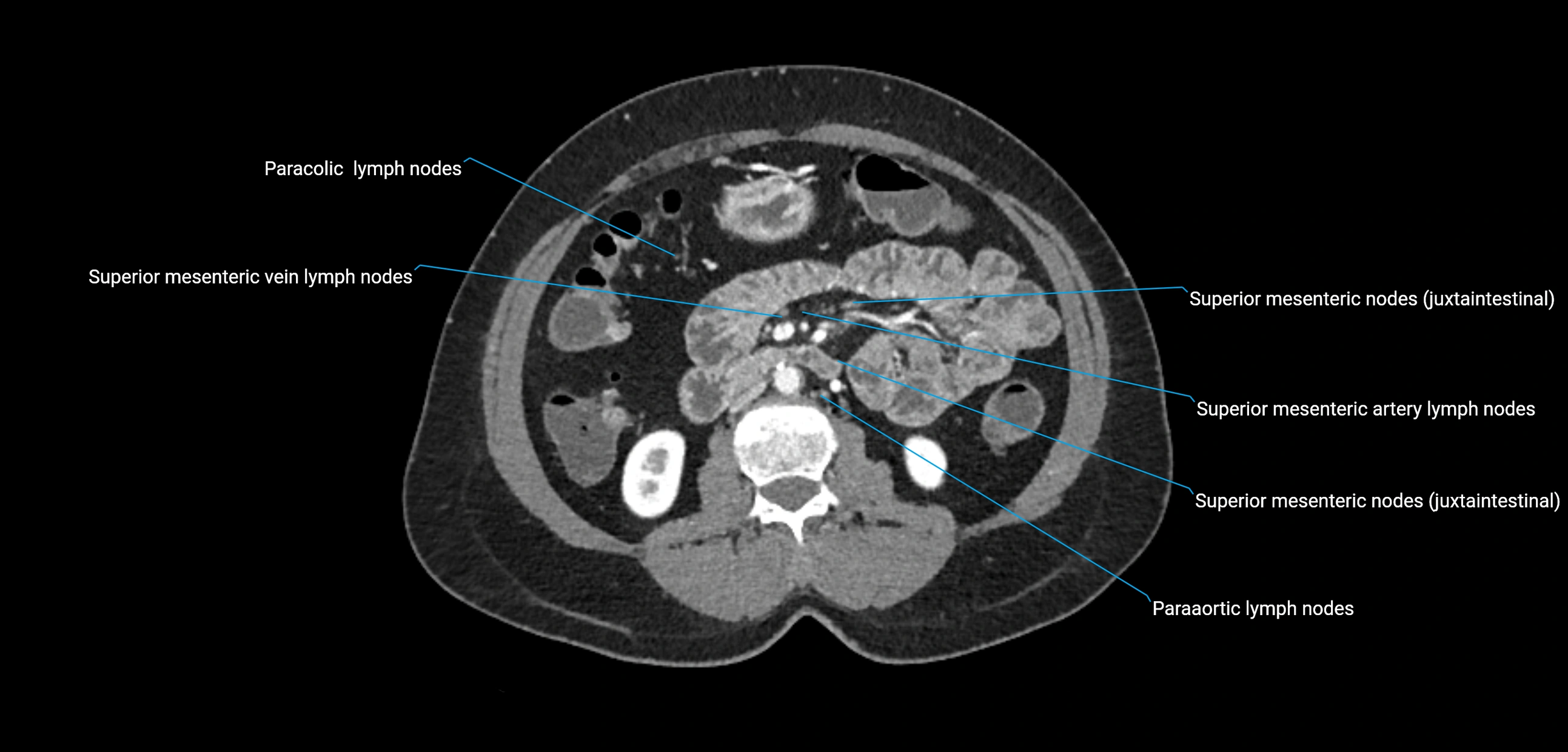 CT ct abdominal lymph nodes  axial cross sectional anatomy  enchanced radiology image -img-00002-00211.webp